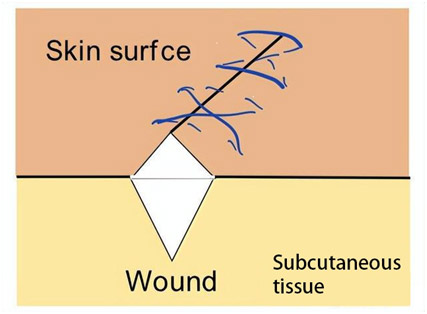 预防外伤瘢痕？有请“YYDS”———急诊整形外科缝合技术！(图1)
